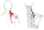 Trigger Points in upper back